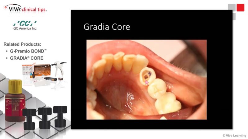 Dr.-Kaminer-on-G-Premio-BOND-and-GRADIA-CORE